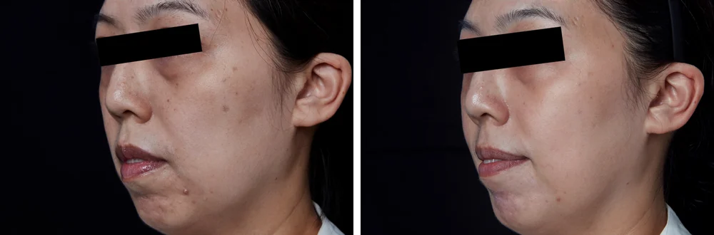 Pico Spot (spot removal) &mdash; before and after treatment