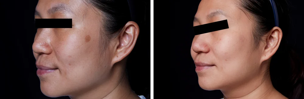 Pico Spot (spot removal) &mdash; before and after treatment