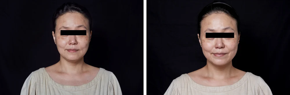 Pico Spot (spot removal) &mdash; before and after treatment