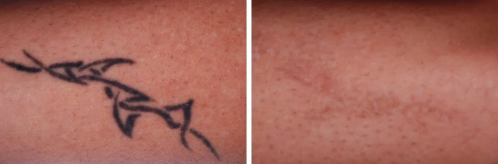 Tattoo removal — before and after treatment