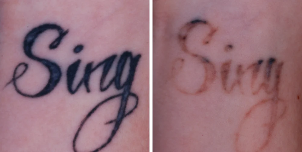 Tattoo removal — before and after treatment