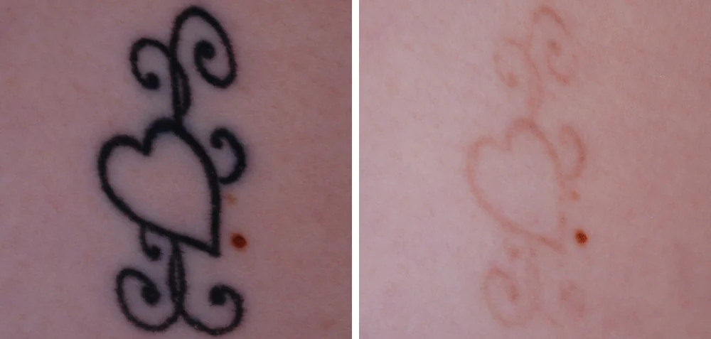 Tattoo removal — before and after treatment