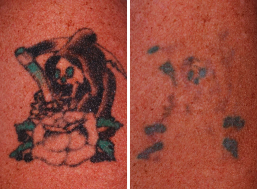 Tattoo removal — before and after treatment