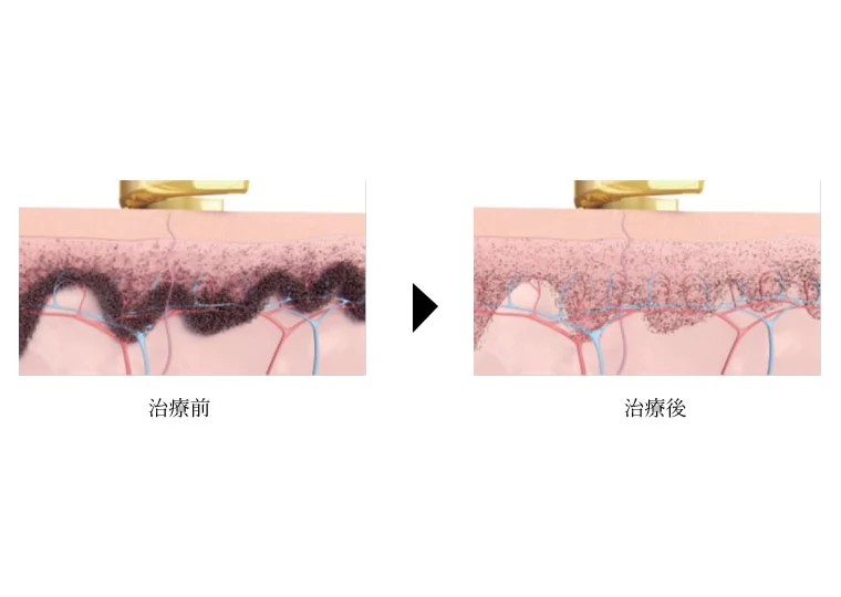 レーザーで色素を細かく砕くしくみ