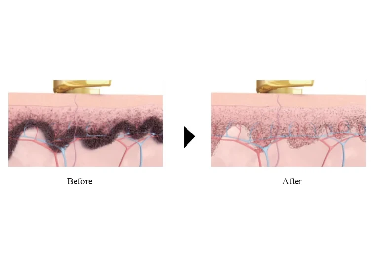 How the laser breaks up pigment